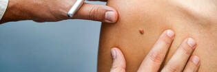examining mole on skin